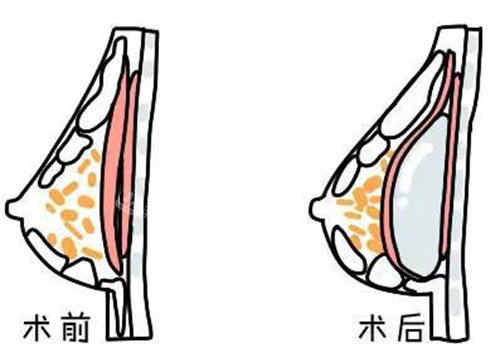 隆胸前后對(duì)比圖