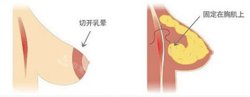 重度胸下垂改善方法