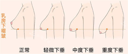 胸部下垂怎么改善？