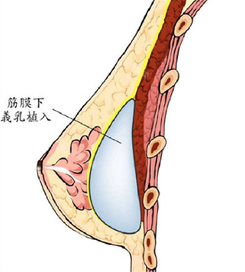 筋膜下植入图