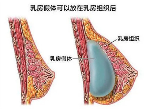 假體隆胸示意圖