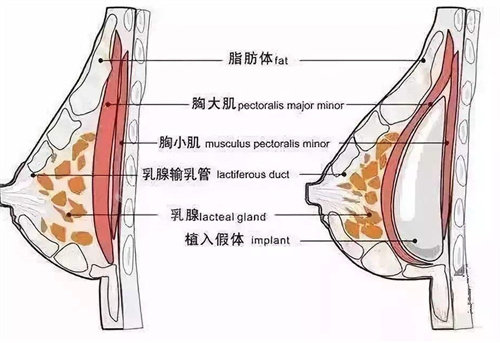 做的曼托隆胸花了2万3，整友真实感受！