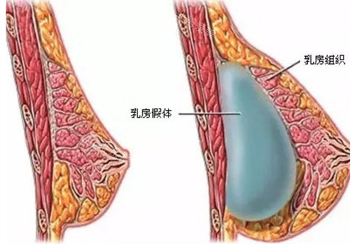 假体隆胸图