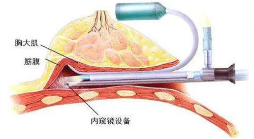 腋下切口内窥镜展示图