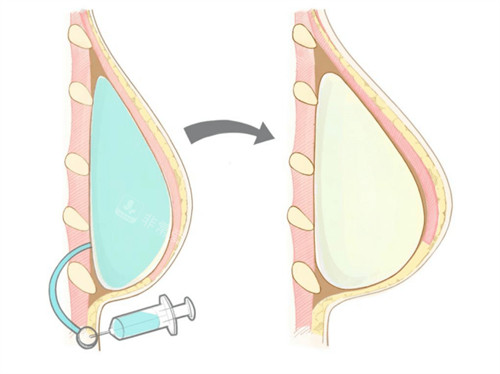 乳房再造手术方式有哪些？