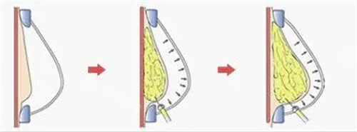 脂肪填充图片