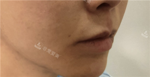 洪性宰内侧人中缩短手术术前照片 洪性宰内侧人中缩短手术术前照片