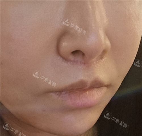 洪性宰内侧人中缩短手术术后照片 洪性宰内侧人中缩短手术术后照片