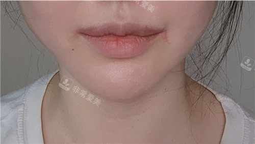 外人中+唇部整形术后两周照片