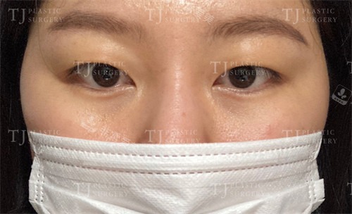 雙眼皮手術(shù)前圖片 雙眼皮手術(shù)前圖片