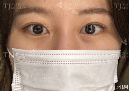 雙眼皮術(shù)后第三個月圖片 雙眼皮術(shù)后第三個月圖片