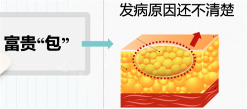富贵包可以通过吸脂改善吗？
