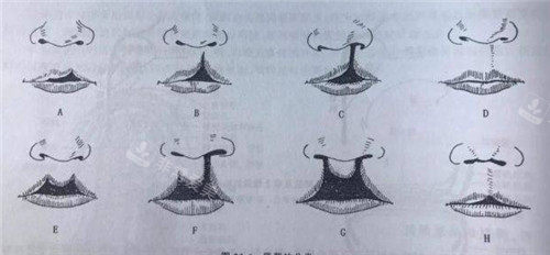 不同情况下的唇裂表现