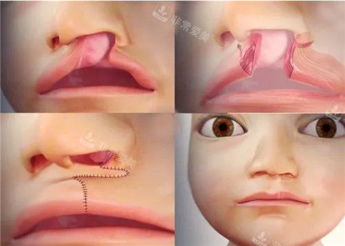 小儿唇裂畸形动画表现图 小儿唇裂畸形动画表现图