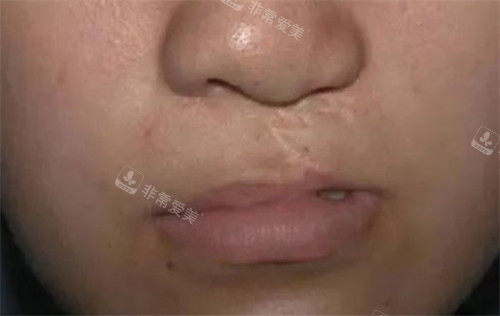需要腭裂修复的图 需要腭裂修复的图
