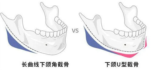 下颌角截骨