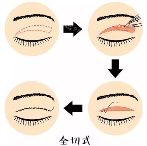 双切式双眼皮