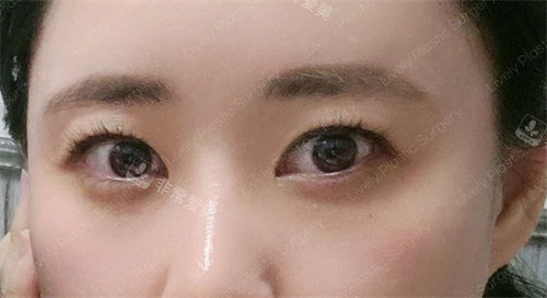 韓國(guó)賴布利LIVELY整形外科術(shù)前照 韓國(guó)賴布利LIVELY整形外科術(shù)前照