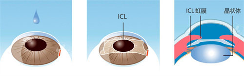 icl晶体植入手术动画图