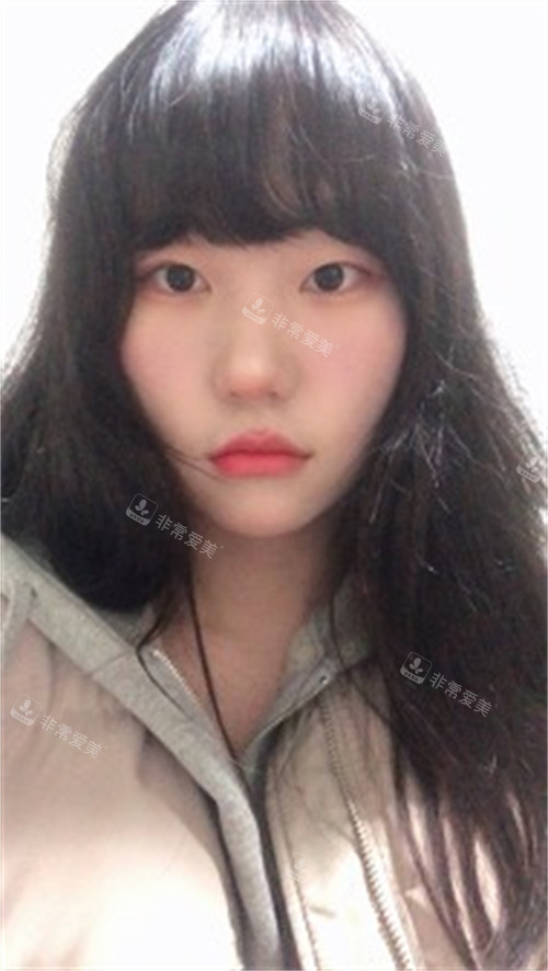 雙眼皮手術(shù)前圖片4 雙眼皮手術(shù)前圖片4