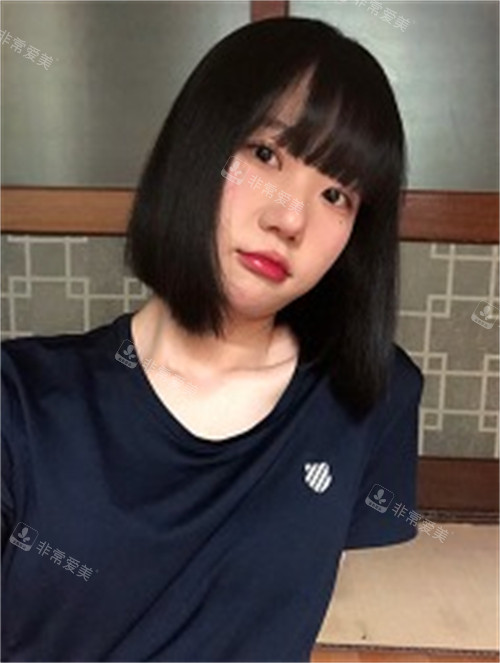 雙眼皮手術(shù)恢復(fù)期圖片 雙眼皮手術(shù)恢復(fù)期圖片