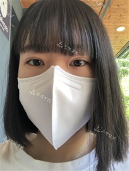 雙眼皮手術(shù)恢復(fù)后圖片 雙眼皮手術(shù)恢復(fù)后圖片