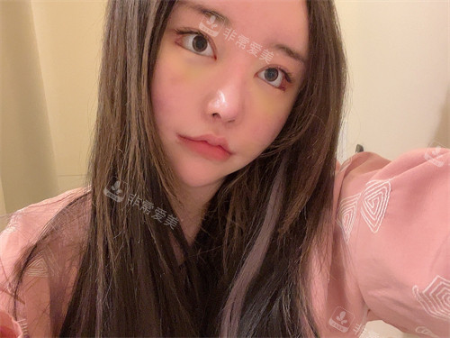 面部修復(fù)手術(shù)恢復(fù)期圖片 面部修復(fù)手術(shù)恢復(fù)期圖片