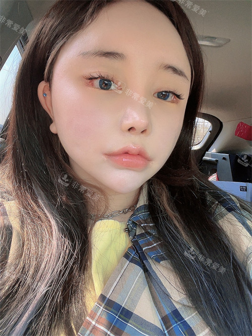 面部脂肪填充后圖片 面部脂肪填充后圖片