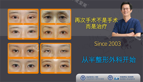 韩国世美整形外科眼修复对比照