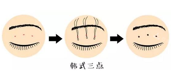 双眼皮<span style=