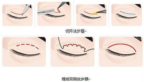 不同双眼皮手术方法图片