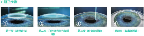 近視矯正手術(shù)流程圖 近視矯正手術(shù)流程圖
