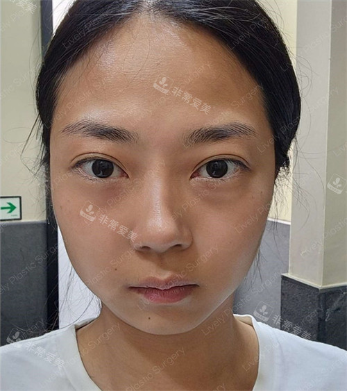 眼底脂肪重排前圖片 眼底脂肪重排前圖片