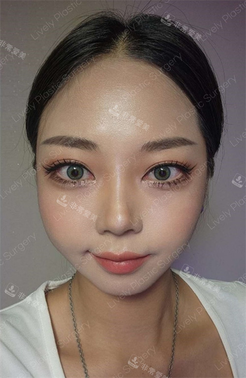 眼底脂肪重排后圖片 眼底脂肪重排后圖片