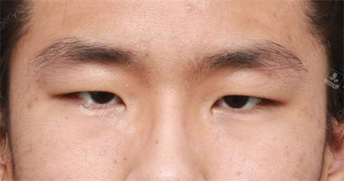 做雙眼皮手術(shù)前