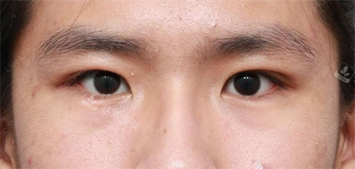 做雙眼皮手術(shù)后