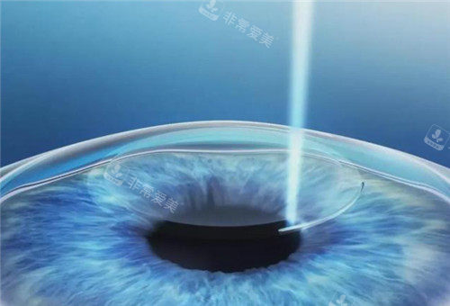 韩国做近视眼激光手术厉害吗？