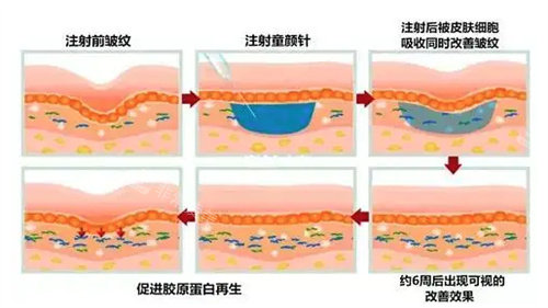 童顏針的作用