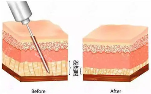 幼态脸需要做哪些整形？