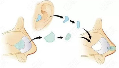 耳软骨隆鼻操作方法