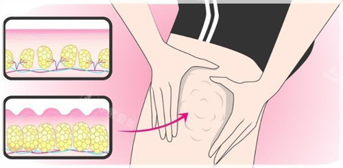 大腿外側(cè)吸脂圖片 大腿外側(cè)吸脂圖片