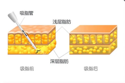 吸脂前后对比图片