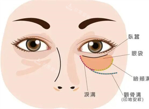 眼袋和卧蚕图片