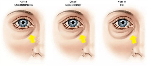 下眼睑凹陷图片
