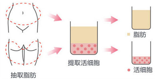 脂肪填充手术流程图 脂肪填充手术流程图