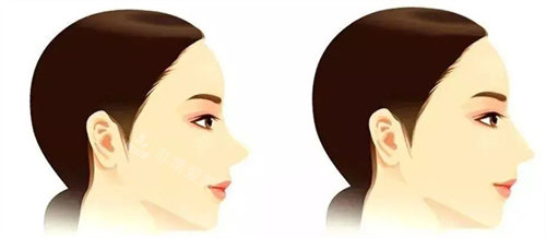 鼻部整形术后展示图 鼻部整形术后展示图