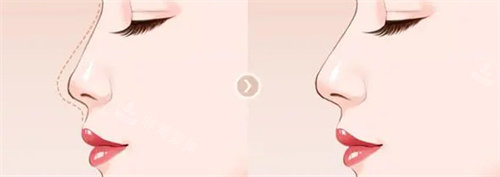 隆鼻前后动画对比图 隆鼻前后动画对比图