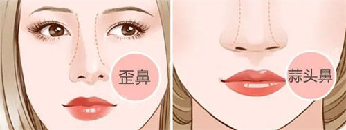 歪鼻和蒜头鼻动画参考图 歪鼻和蒜头鼻动画参考图