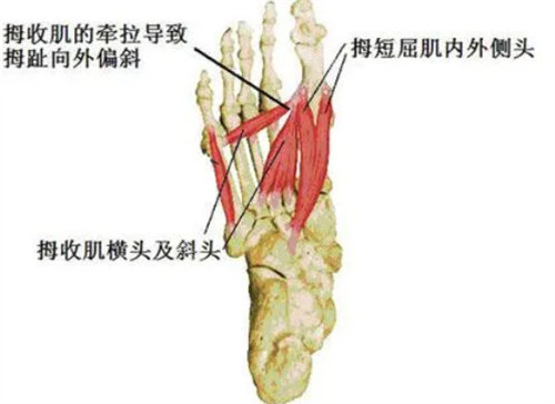 大脚骨能矫正过来吗？