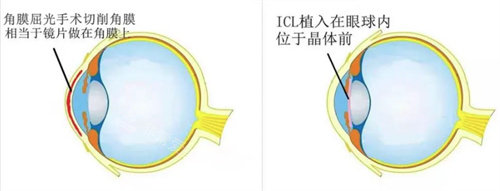 晶状体近视手术操作图